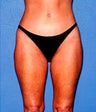 Liposuction