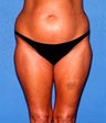 Liposuction