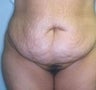 Female patient who underwent surgery for major weight loss 