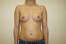 Breast Implants