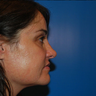 Revision Rhinoplasty