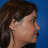 Revision Rhinoplasty