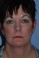 60 year old female SmartLipo of the neck and jawline