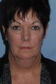 60 year old female SmartLipo of the neck and jawline