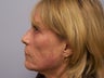 Ablative Laser Resurfacing 