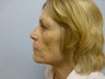 Ablative Laser Resurfacing 