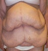 66 year old woman has Belt Lipectomy