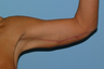 This Cleveland area woman had a Brachioplasty. 