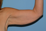 This Cleveland area woman had a Brachioplasty. 