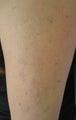 Tattoo Removal