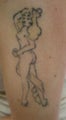 Tattoo Removal