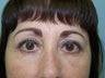 Fat transfer under eyes