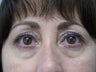 Fat transfer under eyes