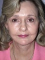 Facelift