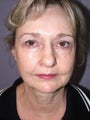 Facelift