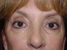 Tear troughs before and after Perlane