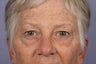 63 yr old Eyelid surgery