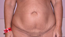 Tummy Tuck