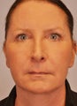 Upper and Lower Eyelid Surgery