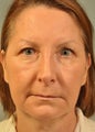 Upper and Lower Eyelid Surgery