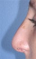 Rhinoplasty