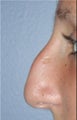 Rhinoplasty