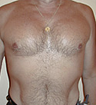 Pec Implants