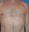 Pec Implants