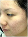Acne Treatment
