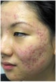 Acne Treatment