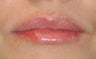 Lip Augmentation