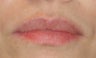 Lip Augmentation