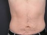 Liposuction Abdomen & Flanks