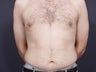 Liposuction Abdomen & Flanks
