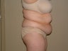 Tummy Tuck