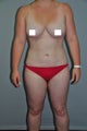 Liposuction