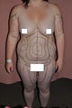 Liposuction
