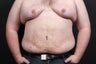 30 year old male underwent large volume liposuction