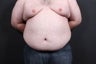 30 year old male underwent large volume liposuction