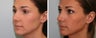 Tip Refinement & Hump Reduction Rhinoplasty Before & After 