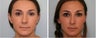 Tip Refinement & Hump Reduction Rhinoplasty Before & After 
