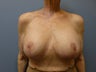 Breast Reconstruction, Implant exchange and breast lift 60 year old woman