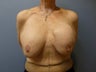 Breast Reconstruction, Implant exchange and breast lift 60 year old woman