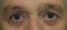Eyelid Surgery