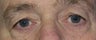 Eyelid Surgery
