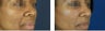 Fillers To Cheeks