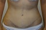 Tummy Tuck
