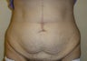 Tummy Tuck