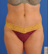 Tummy Tuck