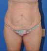 Tummy Tuck